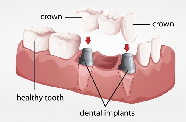 Dental implants Scarborough ON